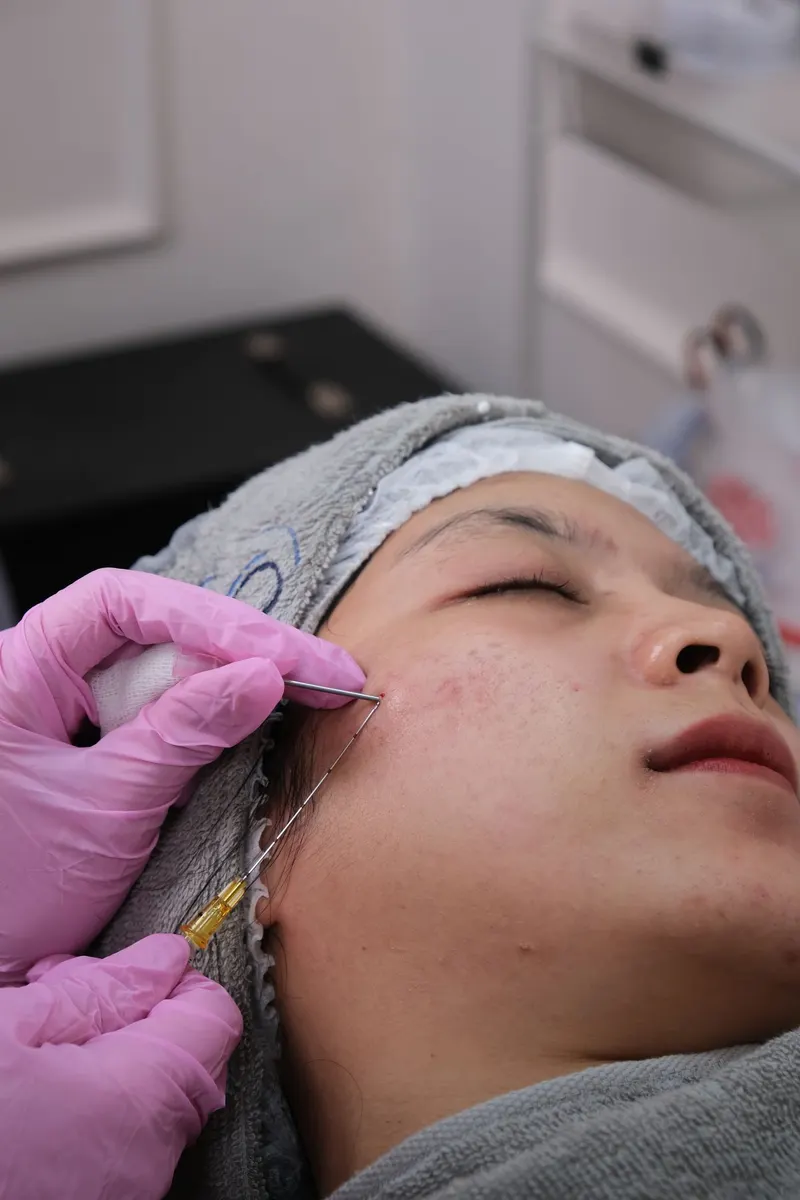 Illustrative photo: a skin renewal procedure